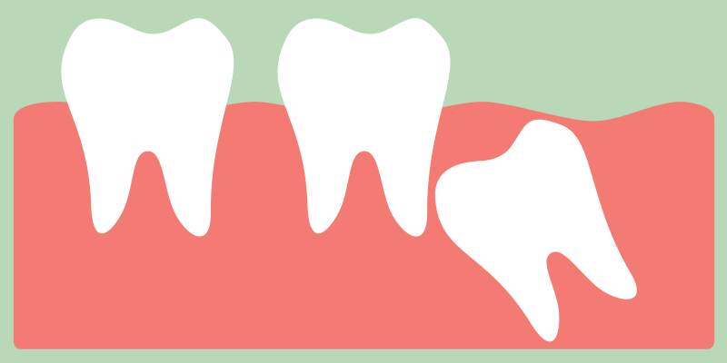 cartoon of an impacted tooth